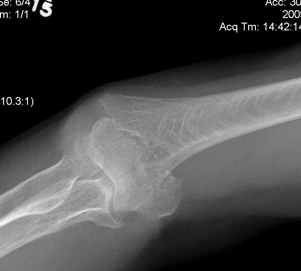 Distal Humerus Fracture